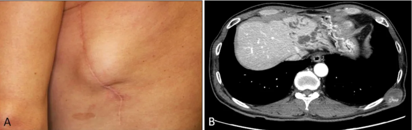 Fig. 1. (A) Solitary hard, fixed dermal mass on the left lateral chest wall. (B) Computed tomography scan revealing the presence of an oval mass with dimensions of 3.6×2.5 cm in the subcutaneous layer adjacent to intercostal muscle