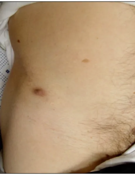 Fig. 1. Brown-colored cutaneous nodule on the linear scar of  right girdle area. 