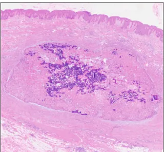 Fig. 2. Extension of mid- to lower dermis by solid tumor (H&amp;E,