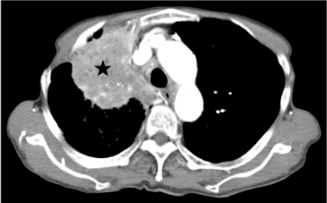 Fig. 3. CT scan showing an ill-defined 7.5×7 cm round  hypodense mass in the right upper lobe of the lung (asterisk).