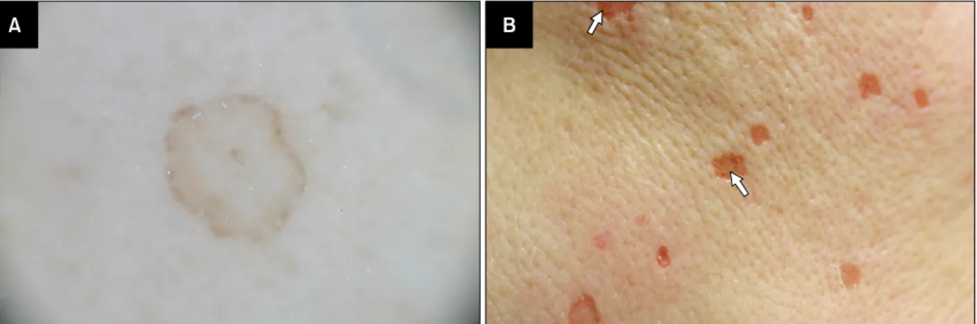 Fig. 1. Dermoscopic findings of a disseminated superficial actinic porokeratosis lesion