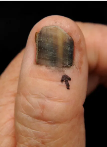 Fig. 1. There is a black patch on the proximal nail fold and mela- mela-nonychia of the left first fingernail.