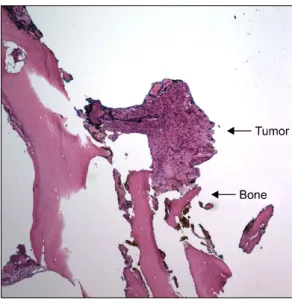 Fig. 3. Medium power view of the subsequent distal thumb  resection shows deep involvement of the tumor reaching the  cortical bone (H&amp;E, original magnification ×100).