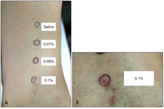 Fig. 2. (A) Urticarial eruptions with itching sensation developed about 1 hour after provocation with a 180 mg dose of fexofenadine.