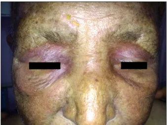 Fig. 3. Eroded atrophic depigmented patch localized on the  labium minus and clitoris.