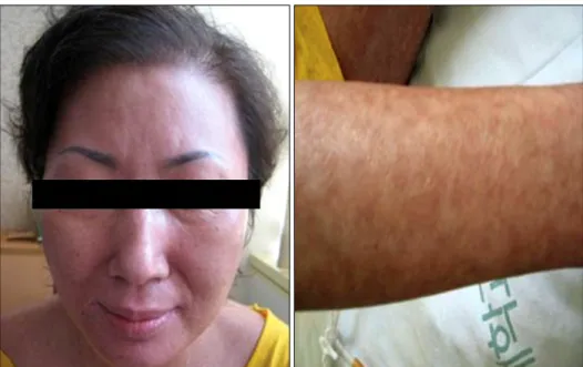 Fig. 2. Picture of the patient 2  weeks after beginning steroid  treat-ment. The skin lesions had  resol-ved but hyperpigmentation  remain-ed
