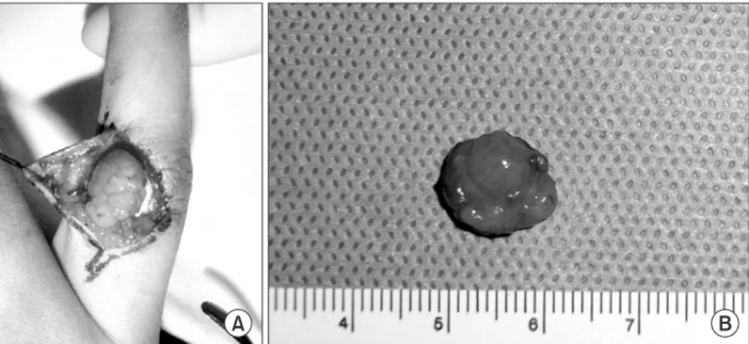 Figure 2. Radiograph shows a round soft tissue lesion on right 4 th proximal  phalanx,  but  neither  bony  erosion  nor  calcification  was  observed.