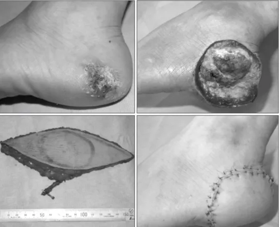 Figure 2. 67 year-old man patient with  malignant melanoma on left heel. Wide  excision and anterolateral thigh free flap is  done over the heel.