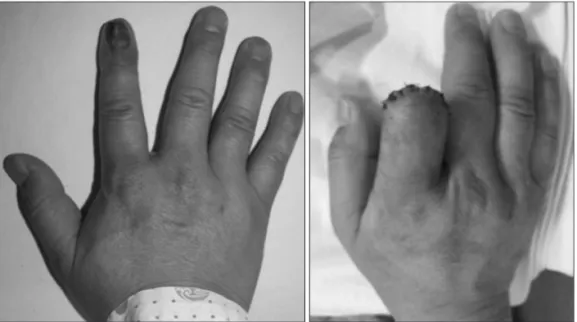 Figure 3. 50 year-old man patient with  malignant melanoma on right 2 nd  finger. 
