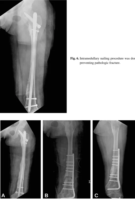 Fig. 6. Intramedullary nailing procedure was done for preventing pathologic fracture.