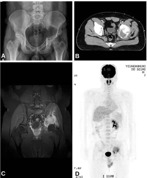 Fig. 1. Simple x-ray shows osteolytic lesion around left acetabulum (A), CT (B) and MRI (C) show bony balooning and soft tissue protruding mass at acetabulum with osteolytic lesion