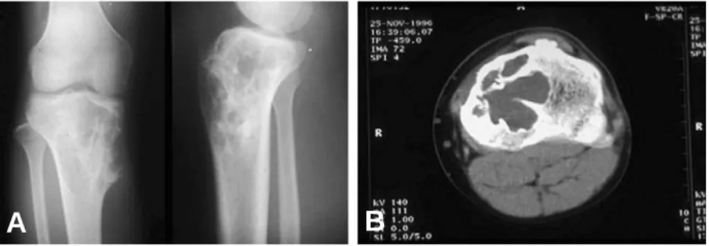 Fig. 1. (A) Anteroposterior and lateral roentgenogram of knee shows osteolytic lesions with multiple cytic lesions on proximal tibia