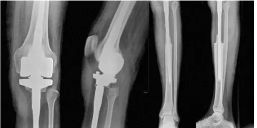 Fig. 6. Anteroposterior and lateral postoperative roentgenogram.