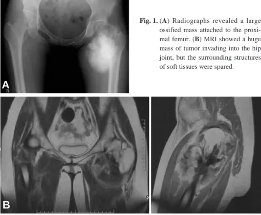 Fig. 1. (A) Radiographs revealed a large ossified mass attached to the  proxi-mal femur