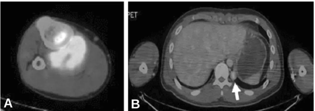 Fig. 3. Histopathologic findings were diagnosed as synovial sarcoma in slide (A) (×100) and (B) (×200).