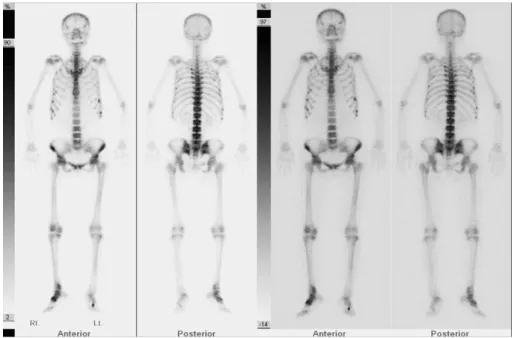 Fig. 1. Whole body bone scan( 99m Tc) shows multifocal hot uptakes on both ribs, right ankle and both feet.