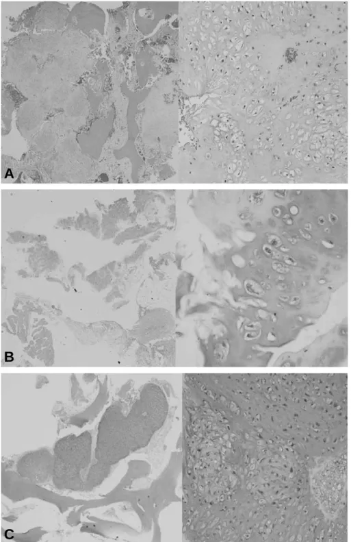 Fig. 5. Hypercellularity, plump nuclei, anisotropic cells, multinucleated cells, mitosis, and multiple chondrosarcoma cells in one lacunae with abundant cartilage matrix are noted in all 3 specimens
