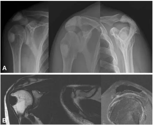 Fig. 6. (A) Plain radiograph taken at one year postoperatively demonstrating packed cement in the acromion and the humoral greater tuberosity, and (B) No evidence of recurrence is evident in this F/U MRI taken at 1-year  post-operatively.