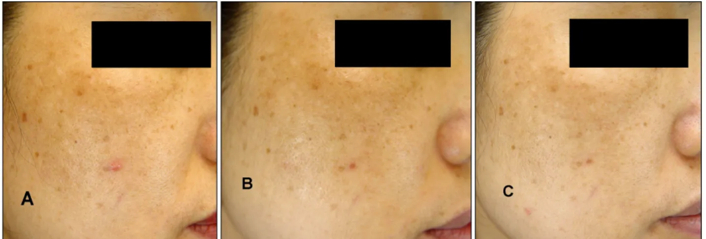 Fig. 2. Patient 1: A 41-year-old woman with melasma was treated with 4-n-butylresorcinol 0.1% cream, and her melanin index (MI) decreased from 221.33 to 210.33 (−11.00)