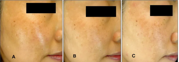Fig. 4. Patient 3: A 44-year-old woman with melasma was treated with 4-n-butylresorcinol 0.1% cream, and her MI decreased from 223.00 to 189.33 (−33.67)