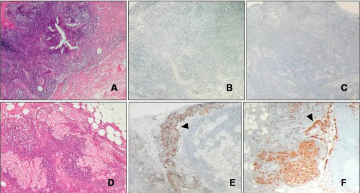 Fig. 2. Histopathological examination of the sentinel lymph node biopsy specimen showing a negative result in case 2 (A: H&amp;E,