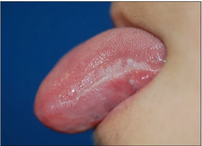 Fig. 1. Tightly adhered whitish patches are located unilaterally in the left border of the tongue showing slightly hairy projections.