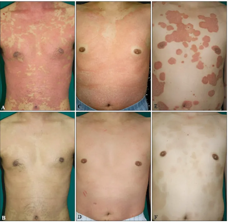 Fig. 1. Clinical photographs of patient 1, 5 and 6 at baseline (A, C, E), and 6 weeks after combination therapy (B), 2 weeks after  combination therapy (D), 6 weeks after combination therapy (F), respectively.