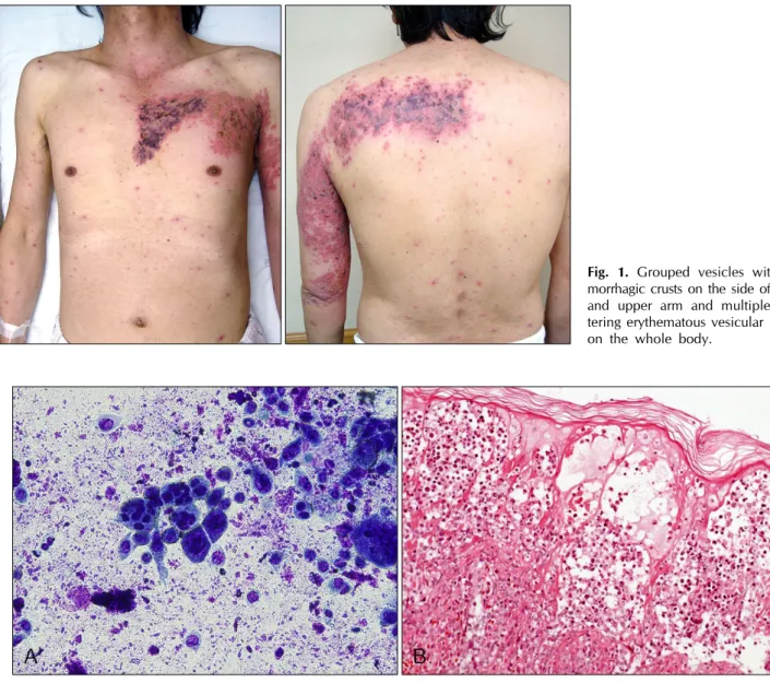 Fig. 1. Grouped vesicles with he- he-morrhagic crusts on the side of trunk and upper arm and multiple  scat-tering erythematous vesicular rashes on the whole body.