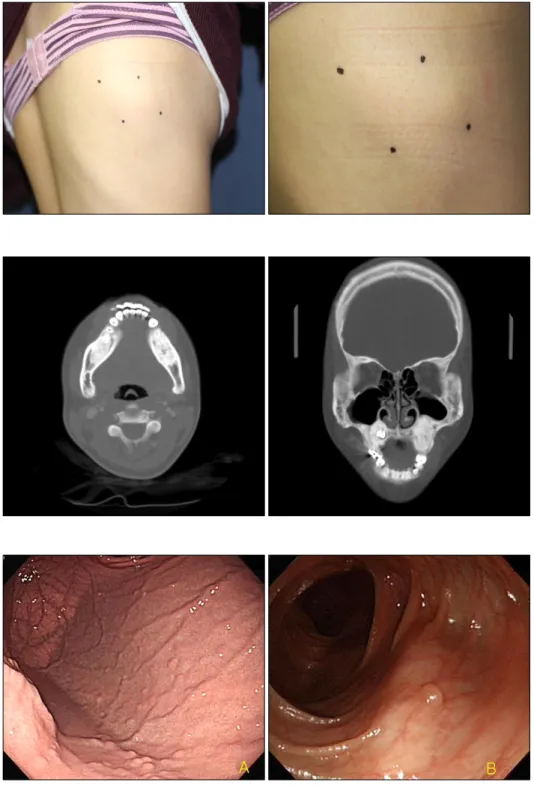 Fig. 3. Endoscopic findings. Numer- Numer-ous small polyps are observed in  stomach (A) and colon (B).