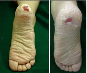 Fig. 4. The ulcerative skin lesions began to improve within 3  weeks after discontinuation of hydroxyurea.