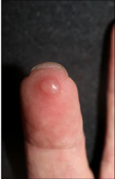 Fig. 1. 0.7×0.5 cm sized rubbery nodule on right fourth finger tip.