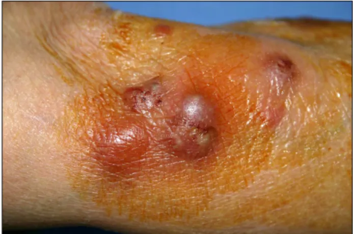 Fig. 1. Multiple erythematous swollen nodules on the left  forearm.