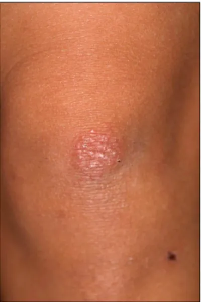 Fig. 1. An erythematous patch, 2.5 cm in diameter, was com- com-posed of multiple flat papules on the left knee.