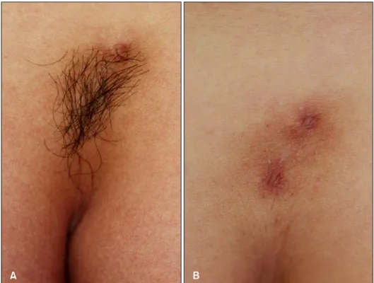 Fig. 1. (A) A localized reverse  triangular shaped hair tuft with  terminal hairs on the lumbosacral area