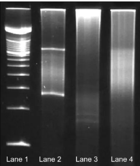 Fig. 3. PCR product run on SSCP gel. Lane 1: molecular weight marker. Lane 2 and Lane 3 show the Vγ1-8 and Vγ11 PCR products from the case, respectively