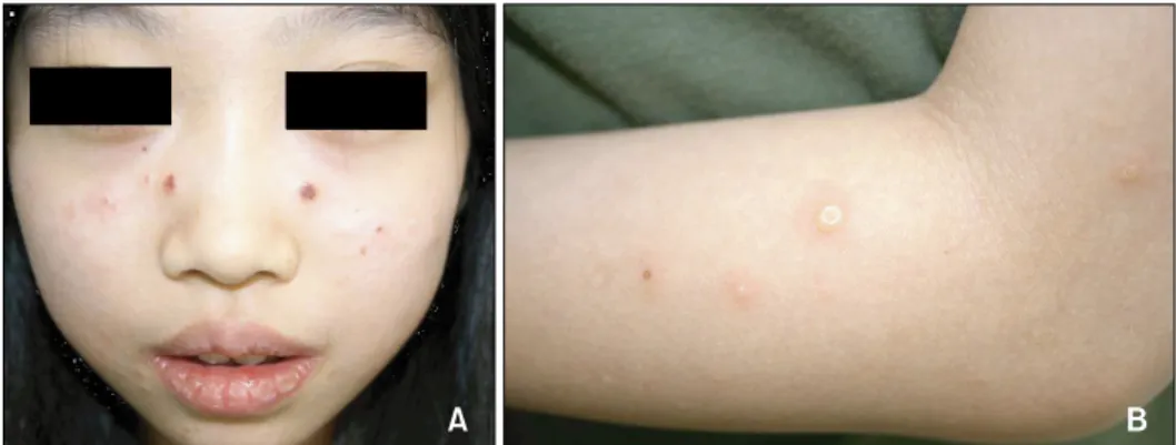 Fig. 1. The patient showed multiple, discrete vesicular eruptions with  scarring on the face (A) and the  extensor surfaces of the forearms  (B).