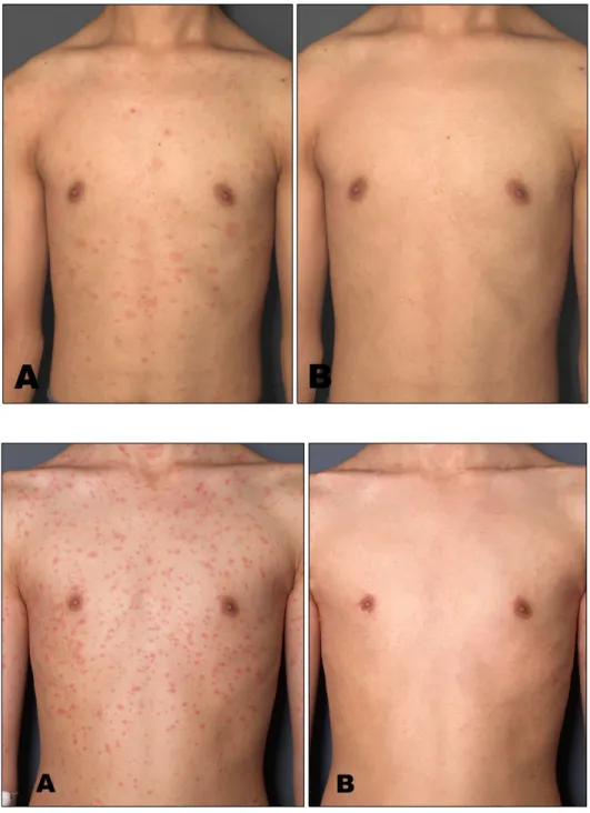 Fig. 3. Clinical features of pityriasis rosea before (A) and after (B) UVA1 phototherapy