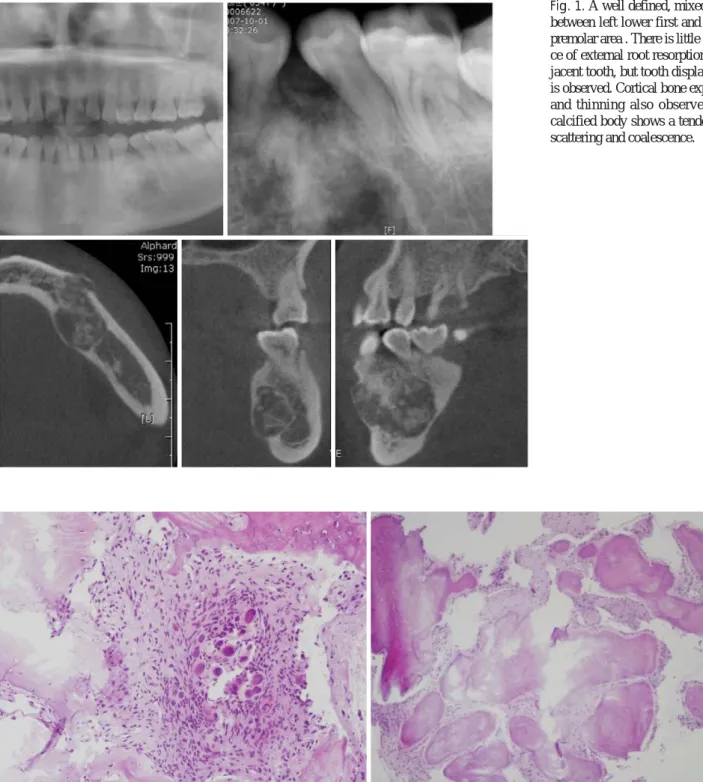 Fig. 2. Osteoid particles are more ovoid and surrounded by the adjacent cellular fibrous stroma (HE×100, ×40).