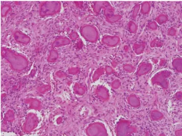 Fig. 5. Microscopically, osteoid particles of various sizes with osteoblastic rimming are surrounded by the adjacent cellular fibrous stroma (HE×100).