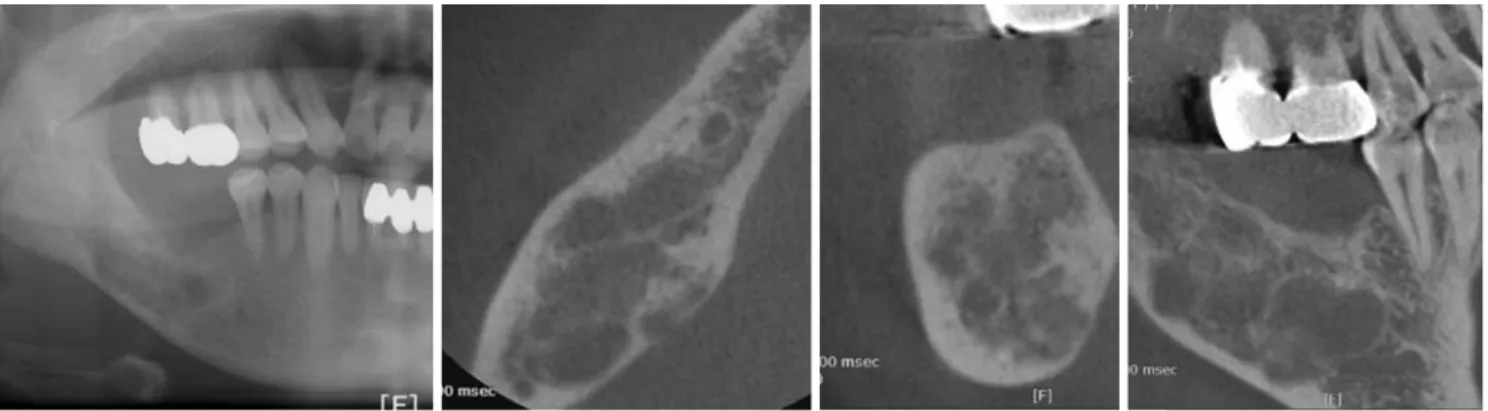 Fig. 7. Microscopically, the tumor reveals characteristic cellular proliferation of fibrous connective tissue containing coalesced calcified structure of various sizes (HE×40).