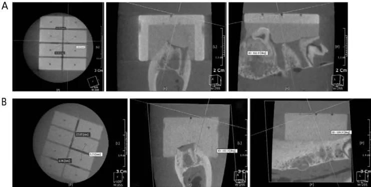 Fig. 2. The decision of insertion point for guide hole and implant by using OnDemand3D (CyberMed Inc., Co., Seoul, Korea) software