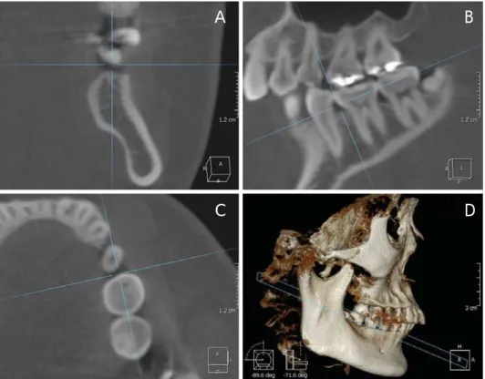 Fig. 1. Buccolingual cross section image (A) at the center portion of the inter-radical alveolar bone of the mesial side of the 1st molar (B, C) on 3 dimensional images of CBCT.