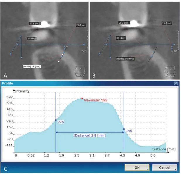 Fig. 2. Measurement of the thickness (B: 2.8 mm) of the buccal cortical bone by using plot profile (C)