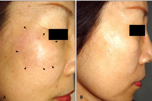 Fig. 1. (A) A slightly indurated,  edematous, and erythematous to brownish plaque on the right  cheek