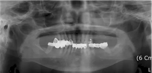 Fig. 2. Intraoral radiographs show no periapical lesion on left maxillary first premolar