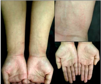 Fig. 1. Disseminated maculopapular exanthema on the upper  extremities.