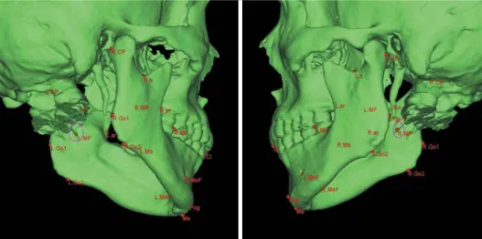Fig. 3. The craniometric planes in three-dimension computed  tomogra-phy (coronal and transverse plane view).