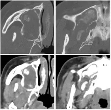 Fig. 3. CBCT images show a tooth crown and patch-like calcified materials inside the lumen of the lesion which occupies and  ex-pands almost completely the right maxillary sinus.