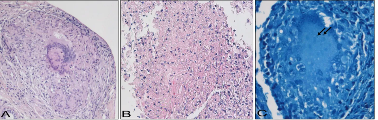 Fig. 2. Histopathologic examination of the margin of the ulcer revealed (A) granuloma composed of epithelioid cells and Langhans-type giant cells (H&amp;E, ×200) and (B) caseous necrosis (H&amp;E, ×200)