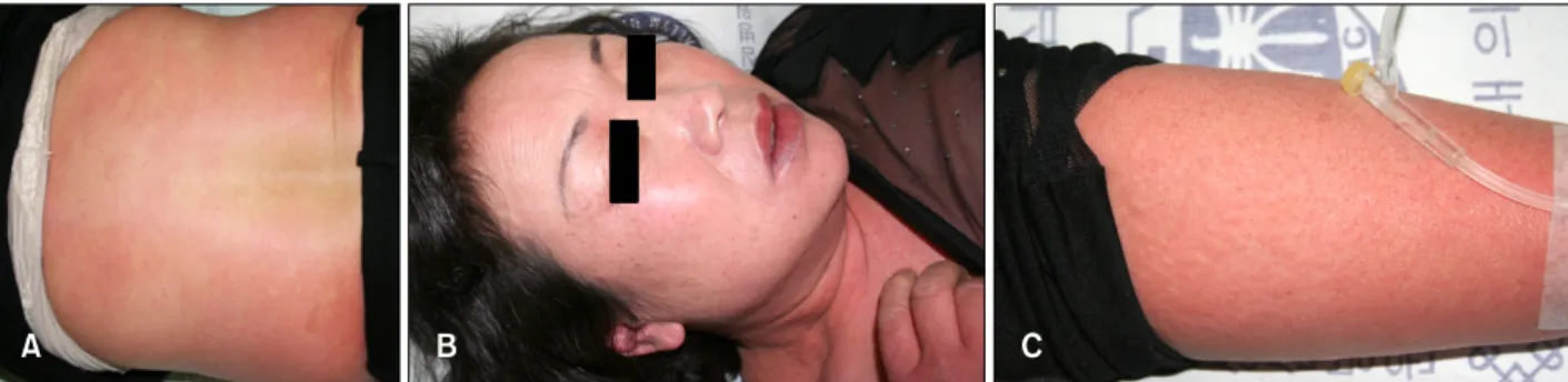 Fig. 1. (A) Twenty minutes after consumption of wheat meal products and subsequent walking, the patient developed itching, generalized erythematous wheals, and mild dyspnea